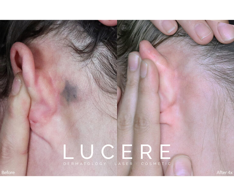 Ear Back Tattoo Removal Before and After