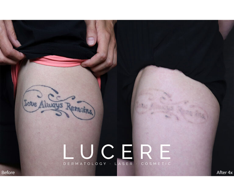 Laser Tattoo Removal on Leg Before and After