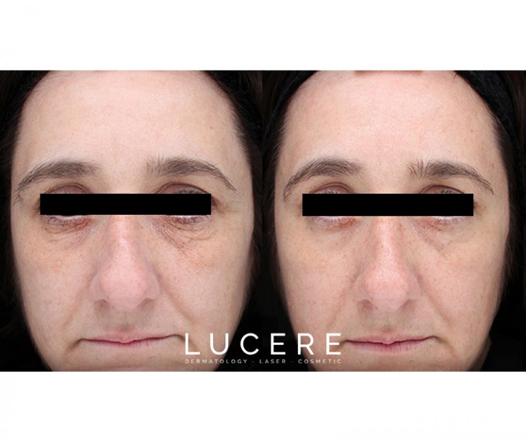 Tempsure skin tightening before and after