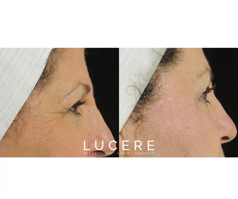 Tempsure before and after