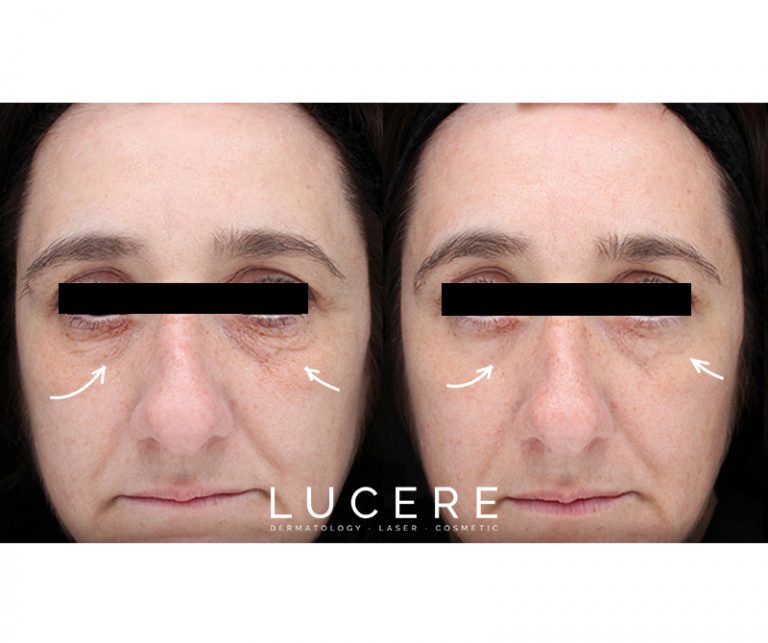 Tempsure skin tightening before and after