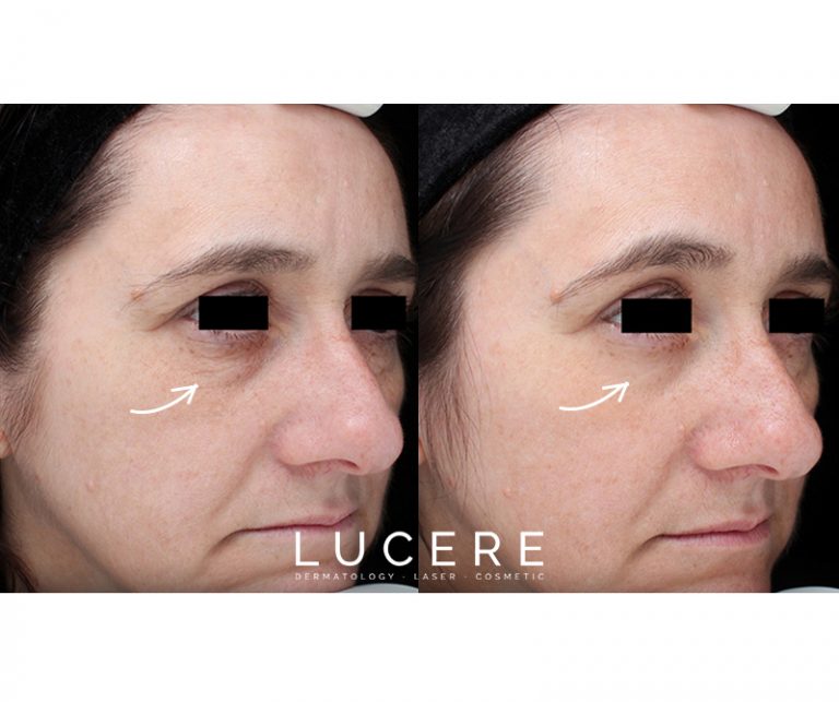 Tempsure skin tightening before and after