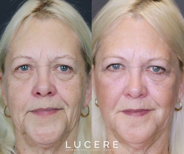 Tempsure skin tightening before and after