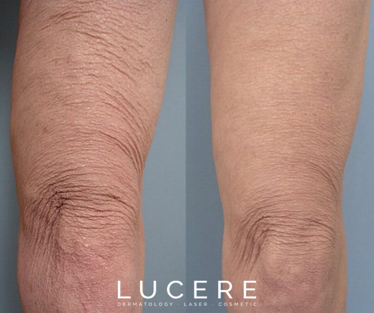 Thermage - Skin Tightening before and after
