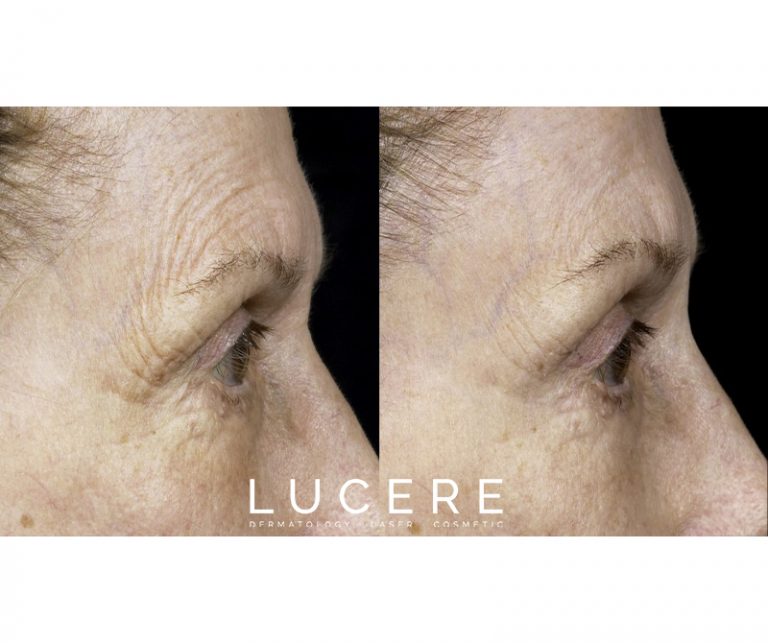 Thermage - Skin Tightening near eye before and after
