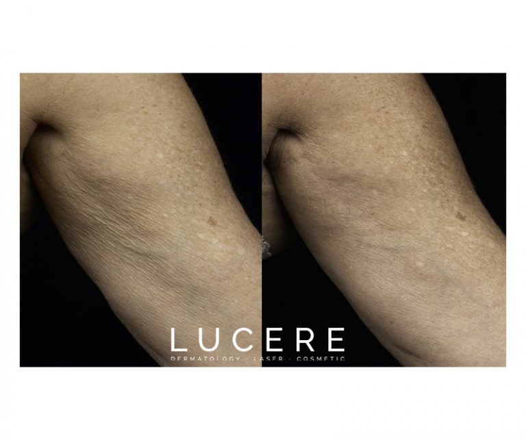 Thermage - Skin Tightening Before and after