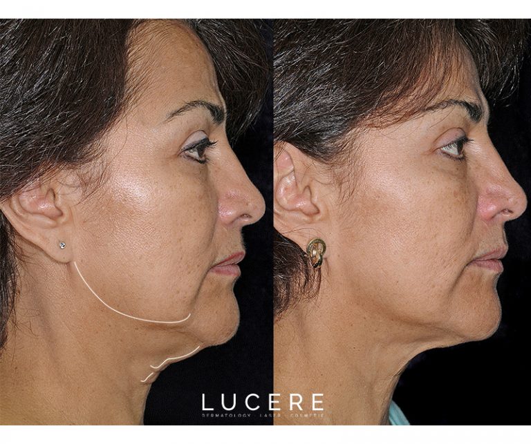 Thermage - Skin Tightening new jaw before and after