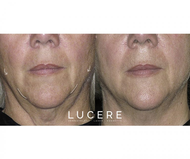 Thermage - Skin Tightening arrow before and after