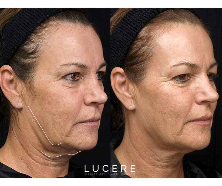 Thermage - Skin Tightening before and after