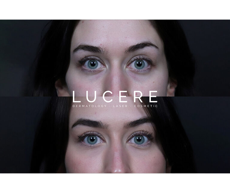 Undereye Filler Treatment front side before and after