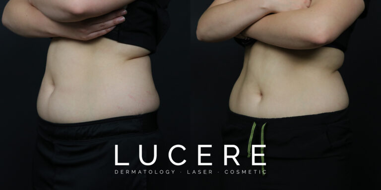sculpsure before and after