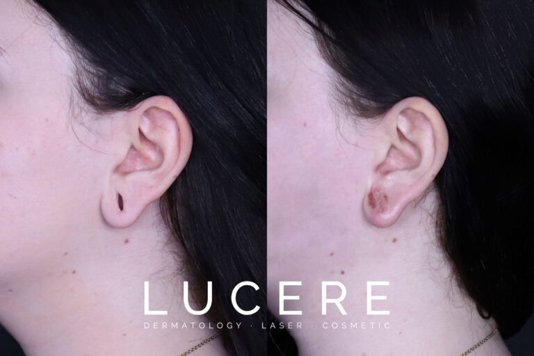 Earlobe filler correction left Side