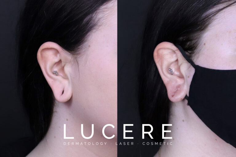Earlobe filler correction right Side before and after