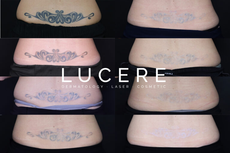 tattoo removal Lower Back Progression before and after