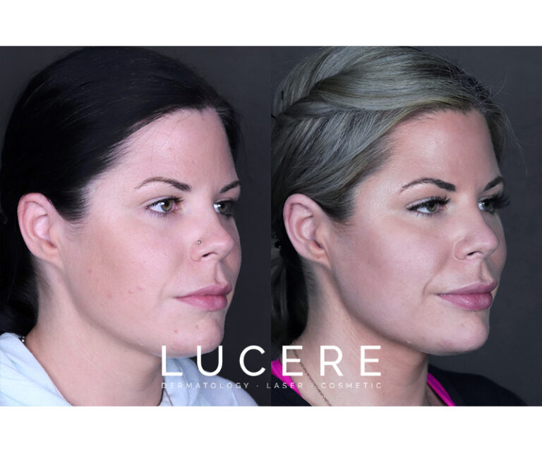 lip fillers before and after results