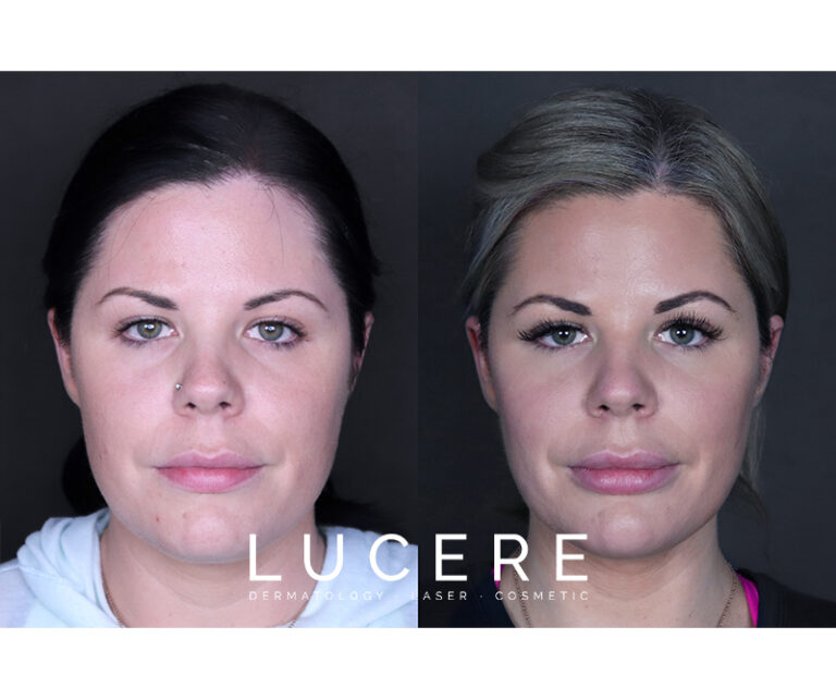 lip fillers before and after results