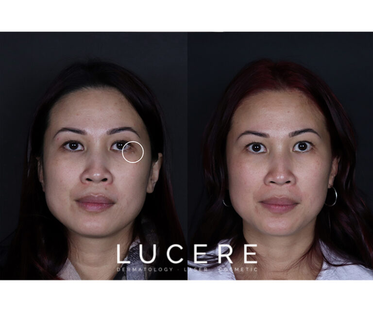 mole removal below eye before and after