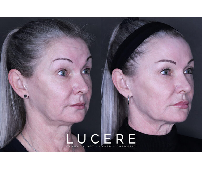 Botox and fillers results