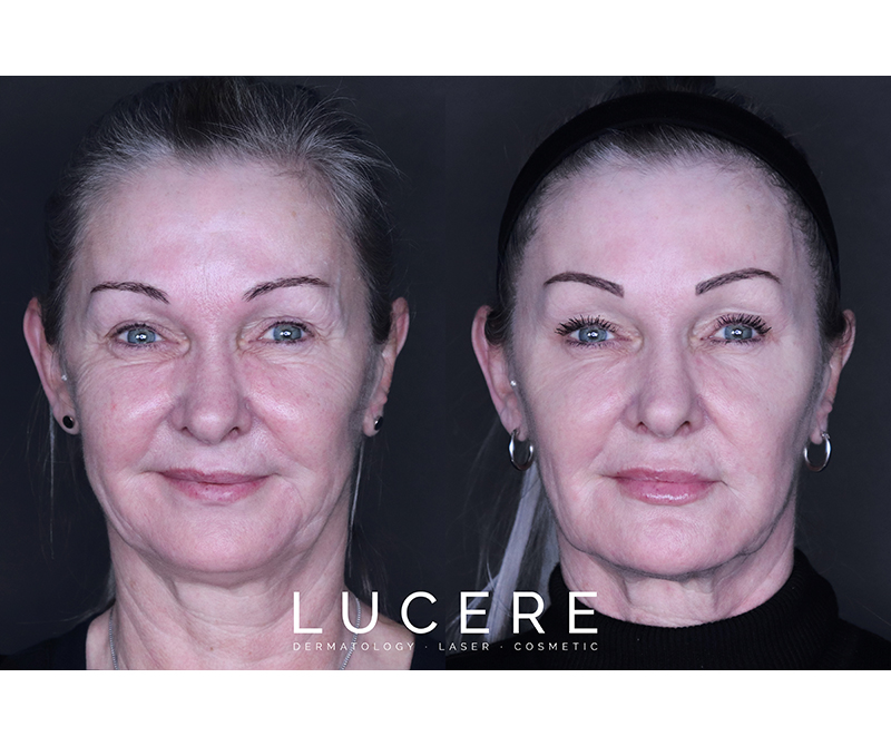 botox before and after