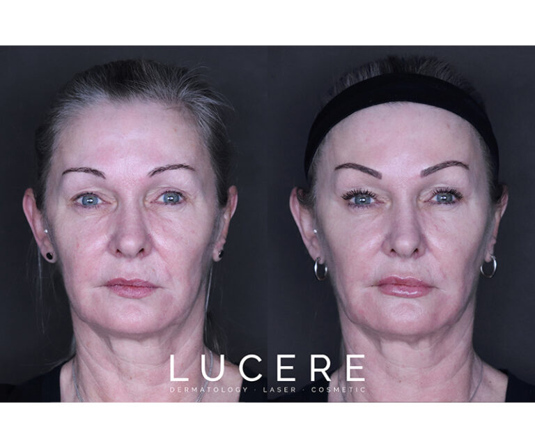 Botox and fillers results front side
