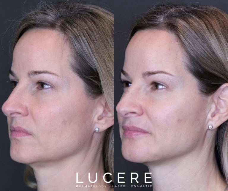 full face botox and fillers before and after