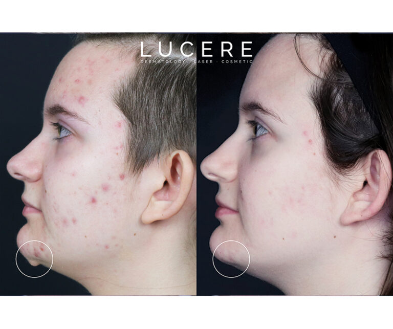 surgical Mole Removal results before and after