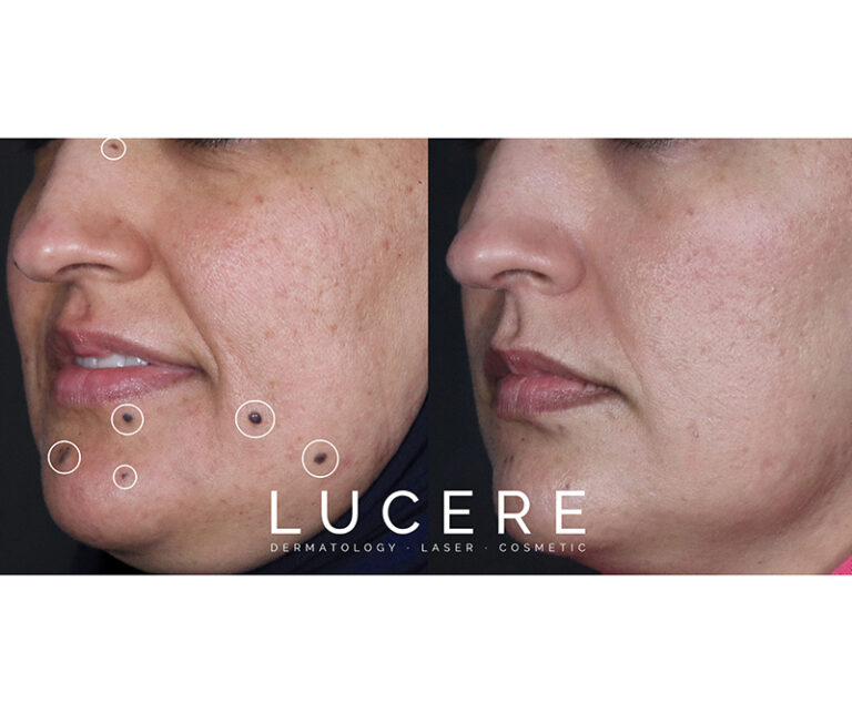 neck mole removal laser before and after