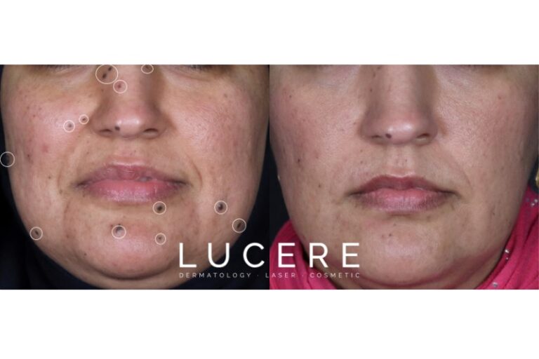 Mole Removal on face before and after