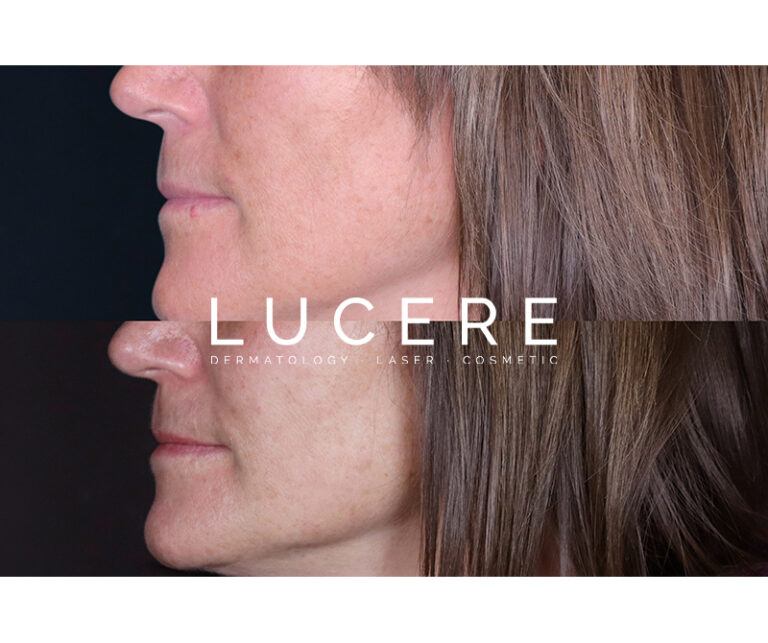 Mole Removal before and after left side