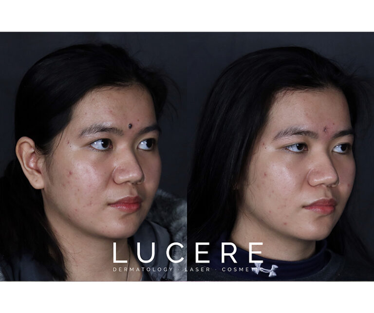 Between two eyebrows Mole Removal before and after