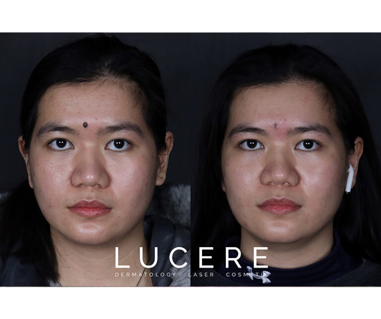 Laser Mole Removal between two eyebrow before and after