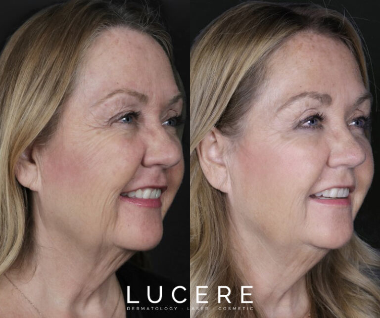full face botox and fillers before and after results