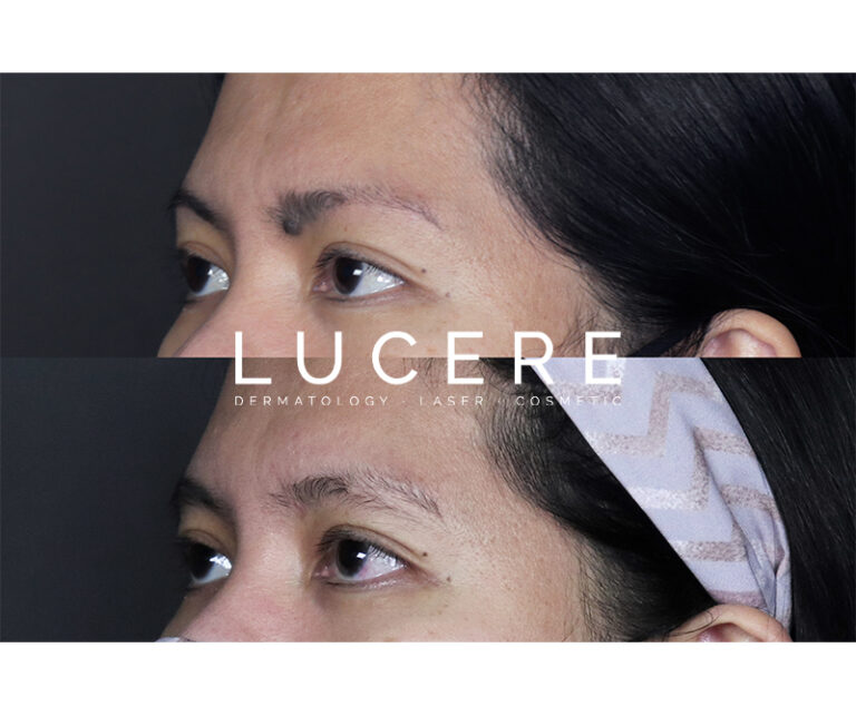 Mole Removal Laser before and after