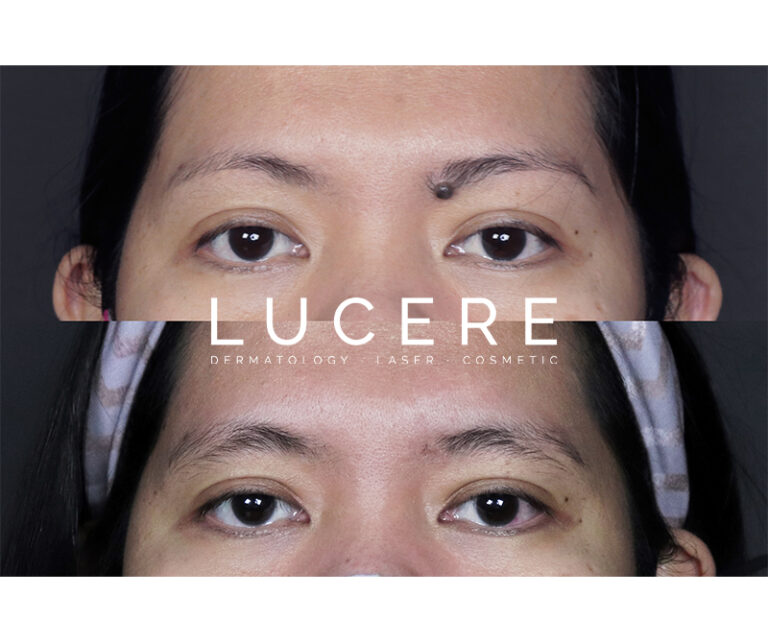 under eyebrow Laser mole removal before and after
