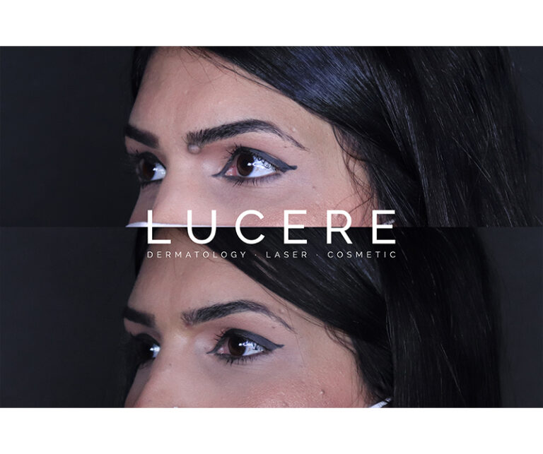 Laser mole removal left side face before and after