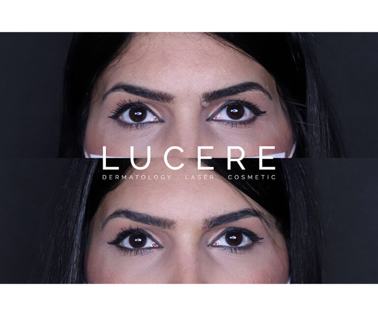 Laser Mole Removal under Eyebrow Before and After