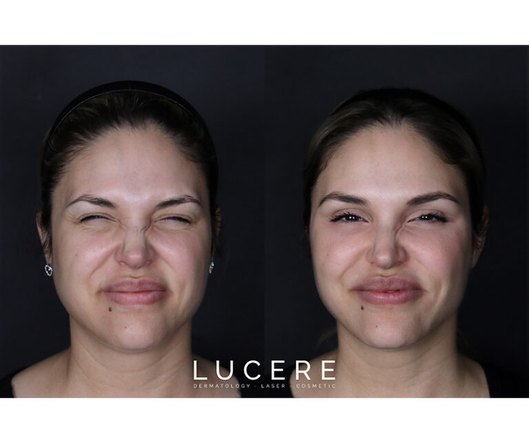Botox and fillers results before and after