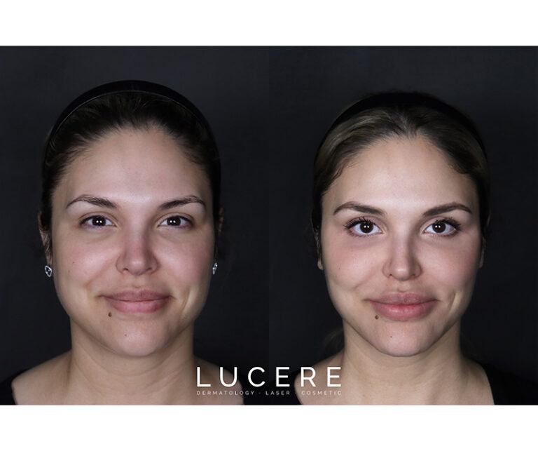 Botox and Filler Front Smile before and after