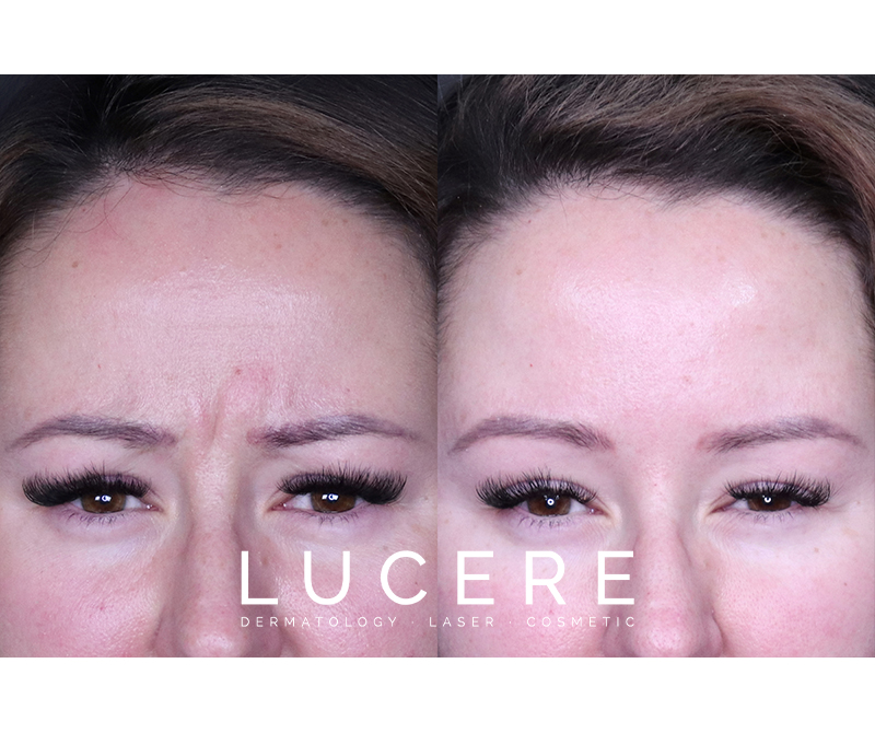 Botox Front Frown frown before and after