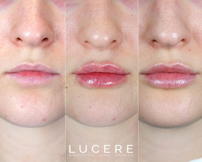 lip fullers by Lucere dermatologist