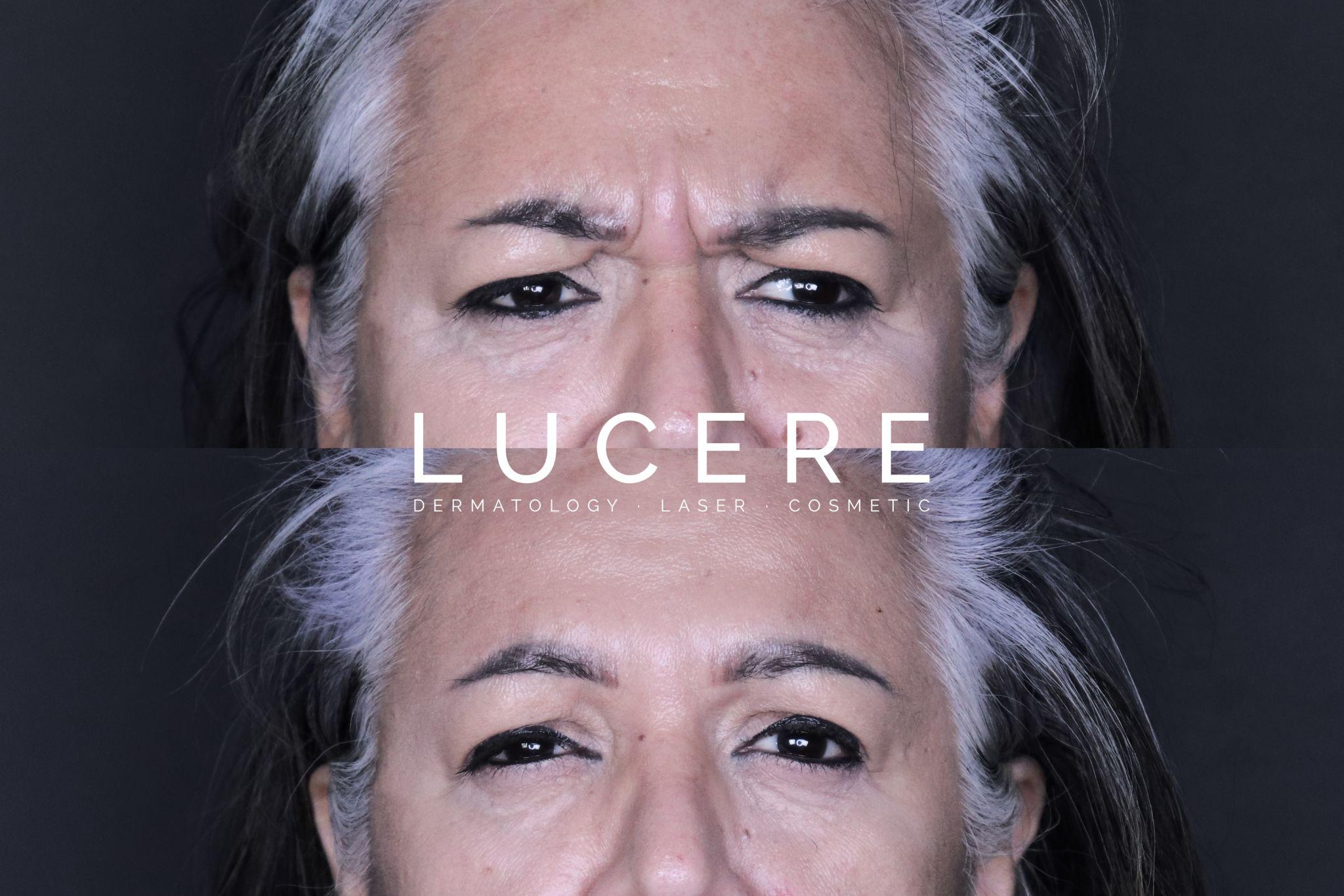botox before and after