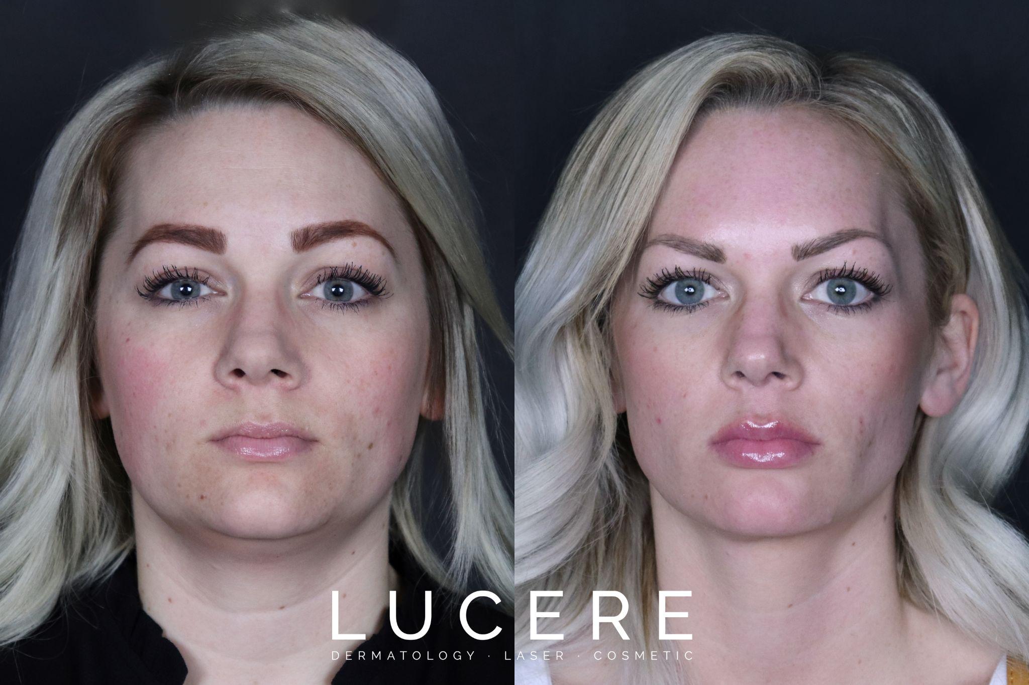 fillers before and after