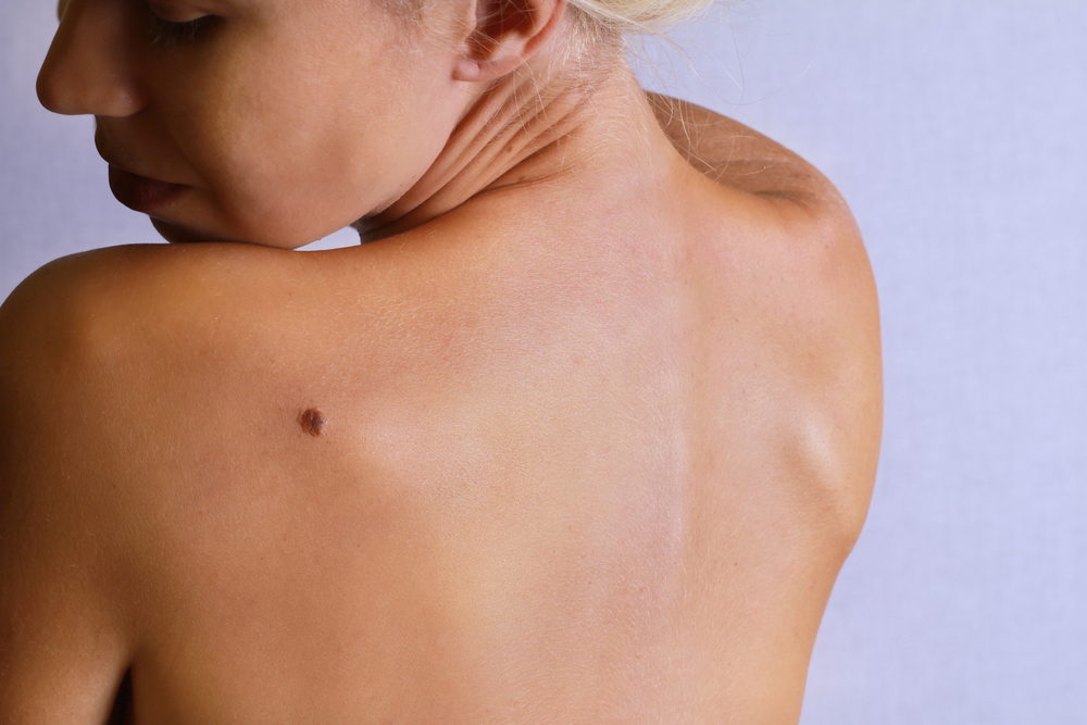 Skin Tag Removal