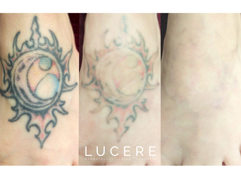 Pico Tattoo Removal - Martineau, I - B&A - Progression - x3 WL web resized