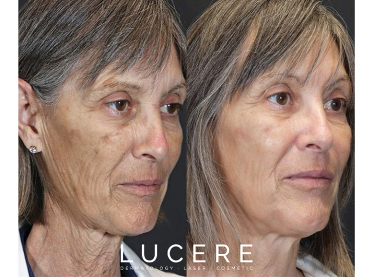 Right-Full-Face transformation