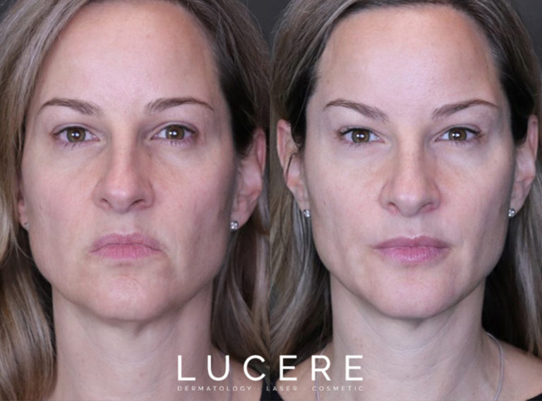 Front Botox & Filler injections before and after