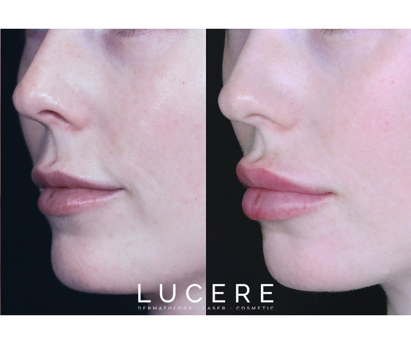 Lip Enhancement: Structure & Volume 2