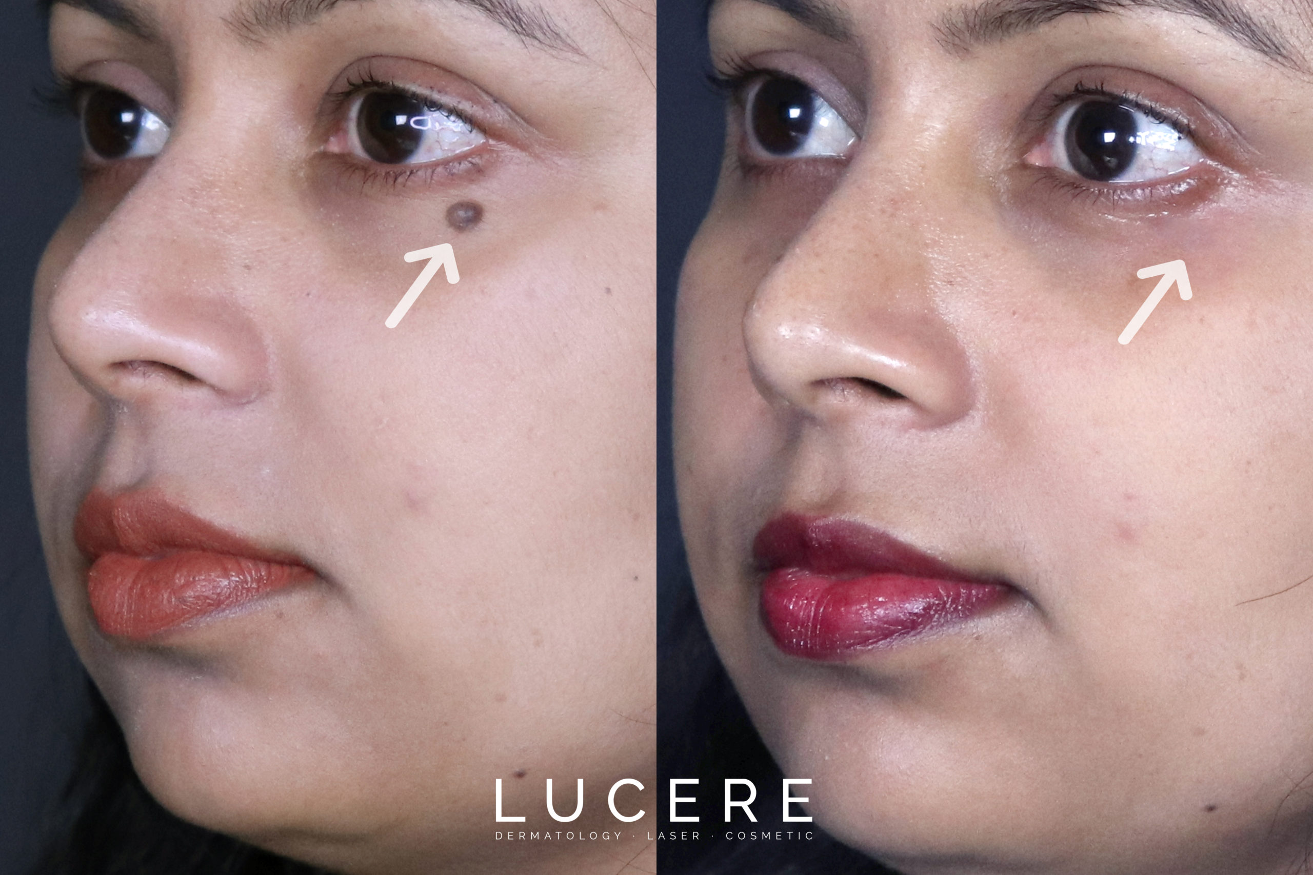 Ipl mole removal Clearance