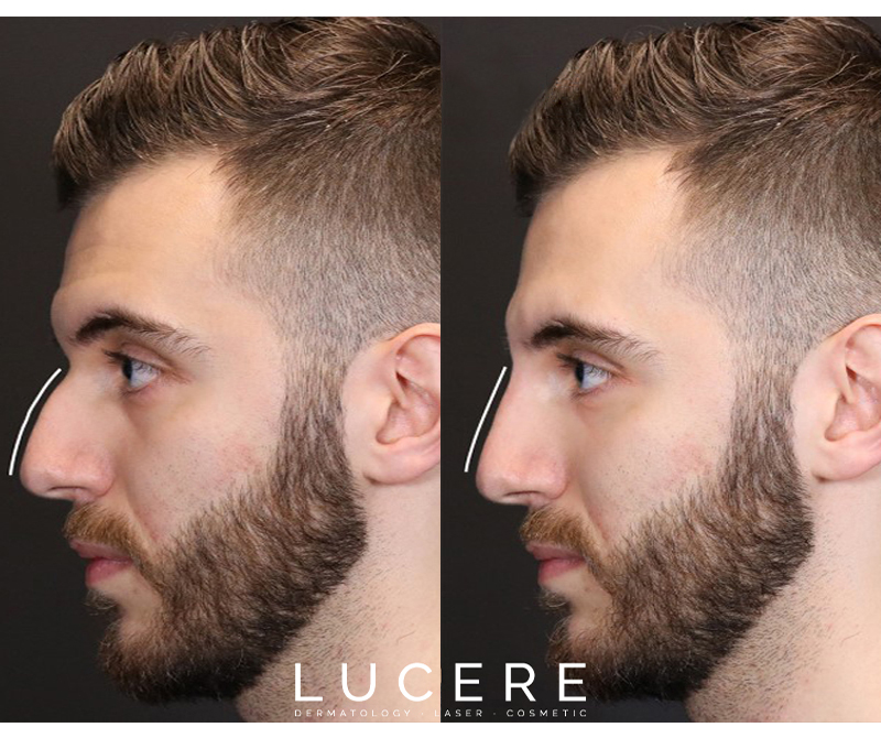 Before and After - Nose Filler