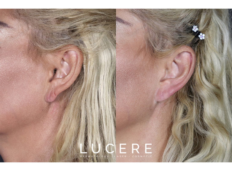 Earlobe Correction before and after